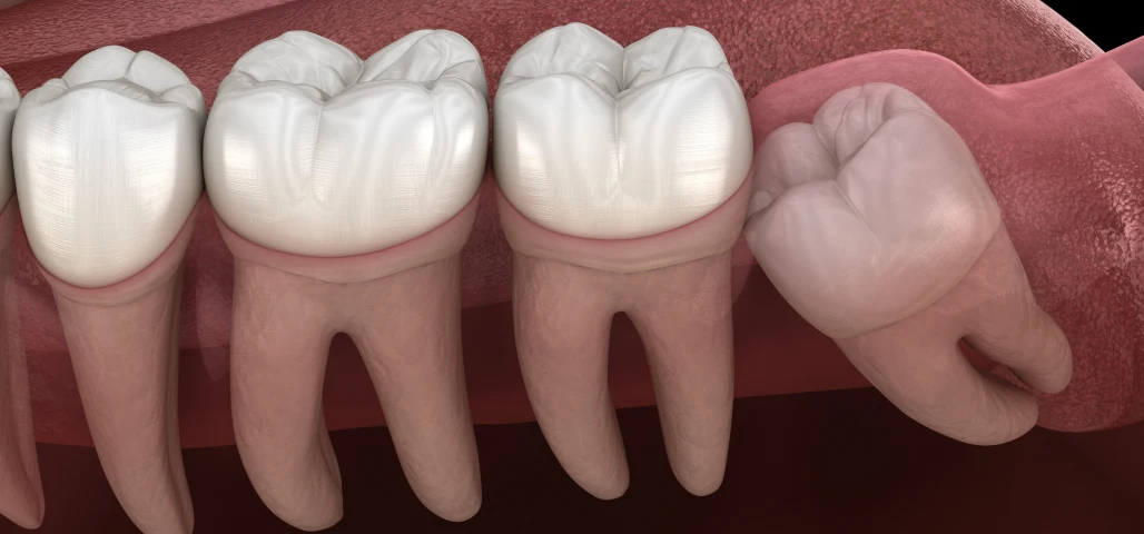 Dégagement de dents incluses 