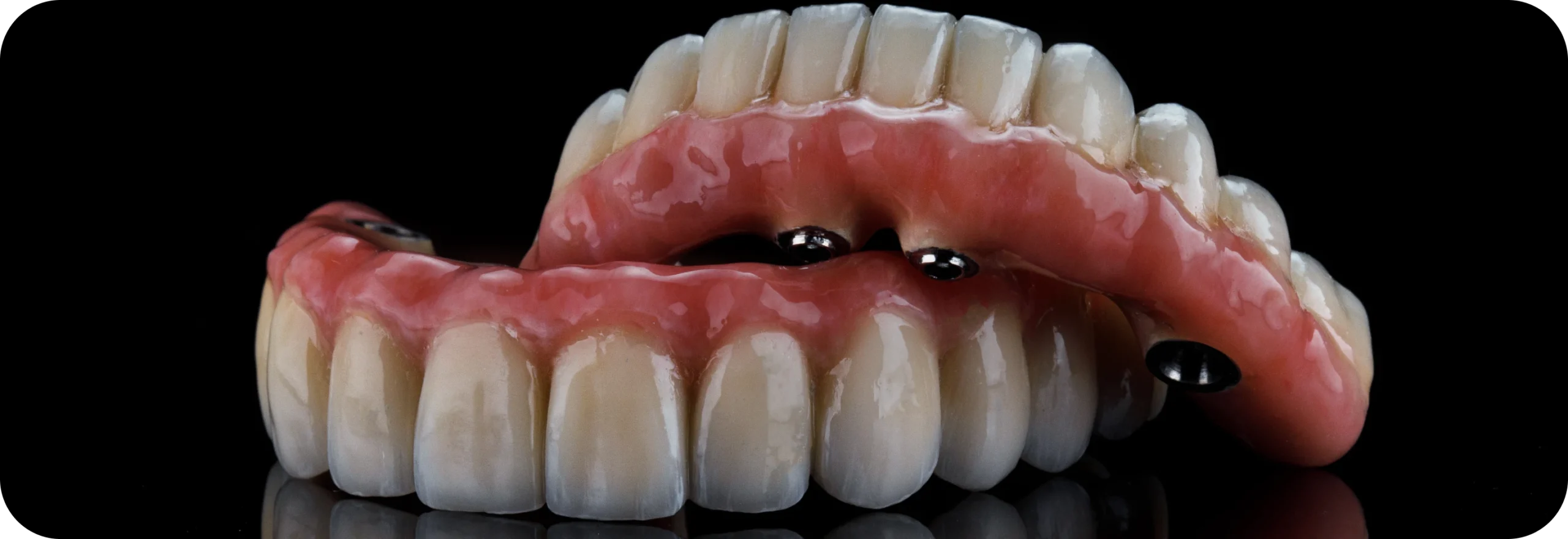 Prothèse sur implants  Dr Alexis Duroux, Dentiste à Cannes