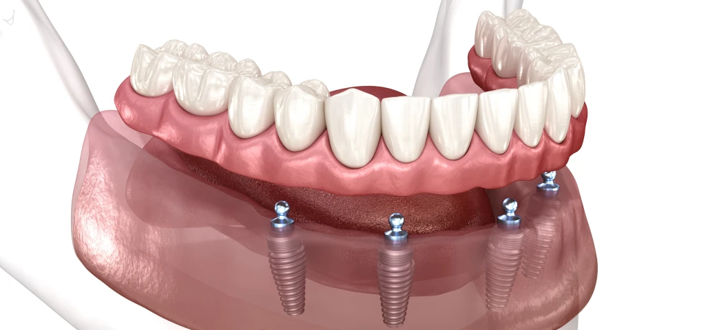 Prothèse sur implants 