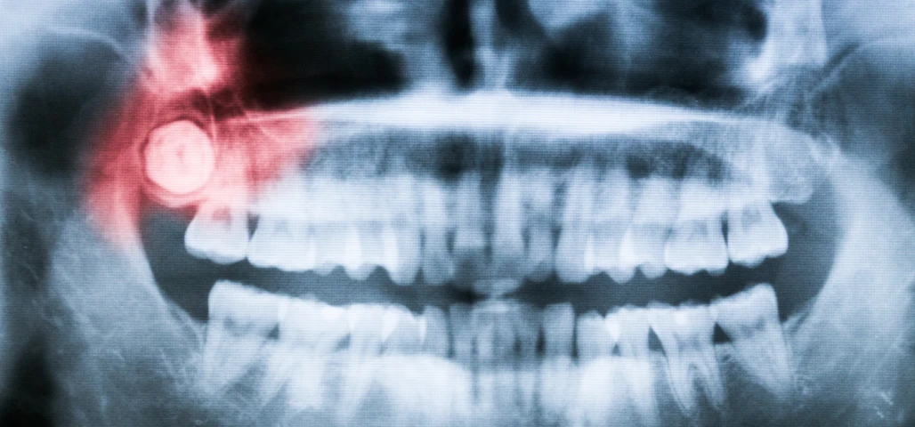 Extractions de dents incluses 