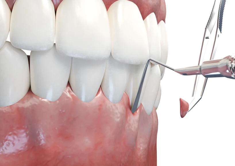 Chirurgie muco-gingivale  Dr Alexis Duroux, Dentiste à Cannes