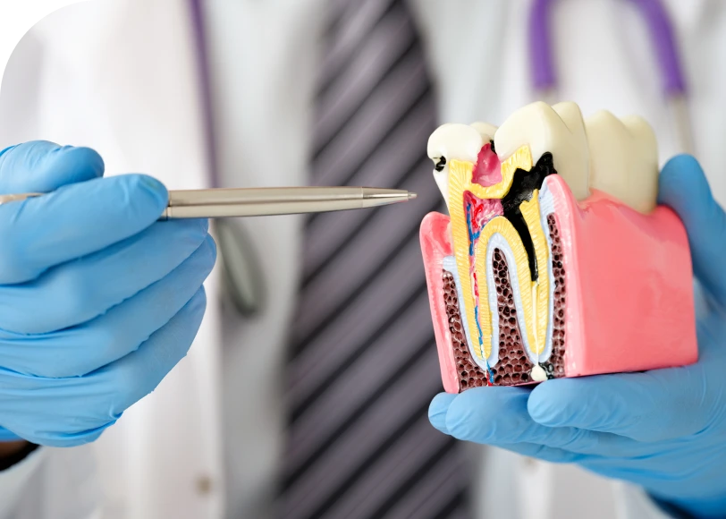 Caries Dr Alexis Duroux, Dentiste à Cannes