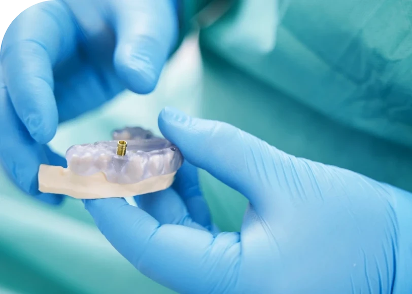 Chirurgie guidée  Dr Alexis Duroux, Dentiste à Cannes