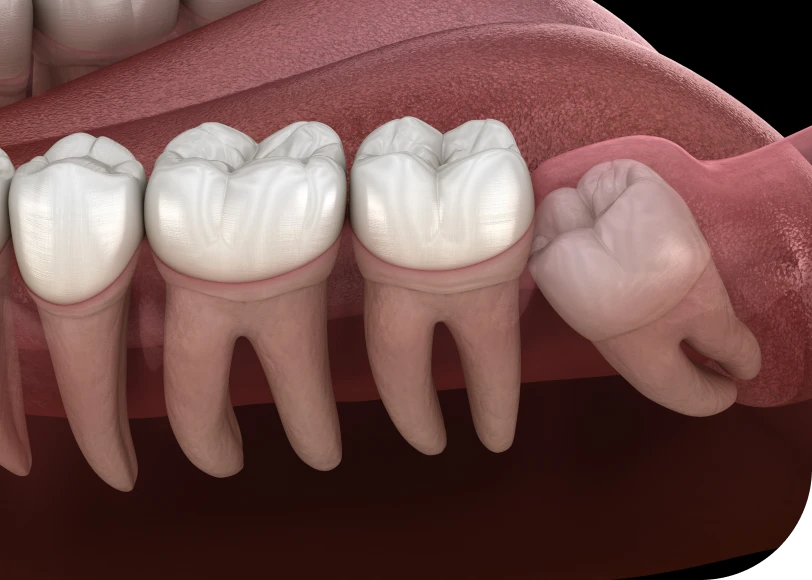 Chirurgie guidée  Dr Alexis Duroux, Dentiste à Cannes