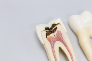 Caries Dr Alexis Duroux, Dentiste à Cannes