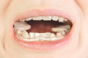 Caries Dr Alexis Duroux, Dentiste à Cannes