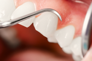 Caries Dr Alexis Duroux, Dentiste à Cannes