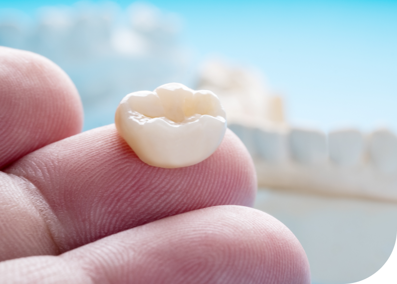 Couronnes céramiques  Dr Alexis Duroux, Dentiste à Cannes