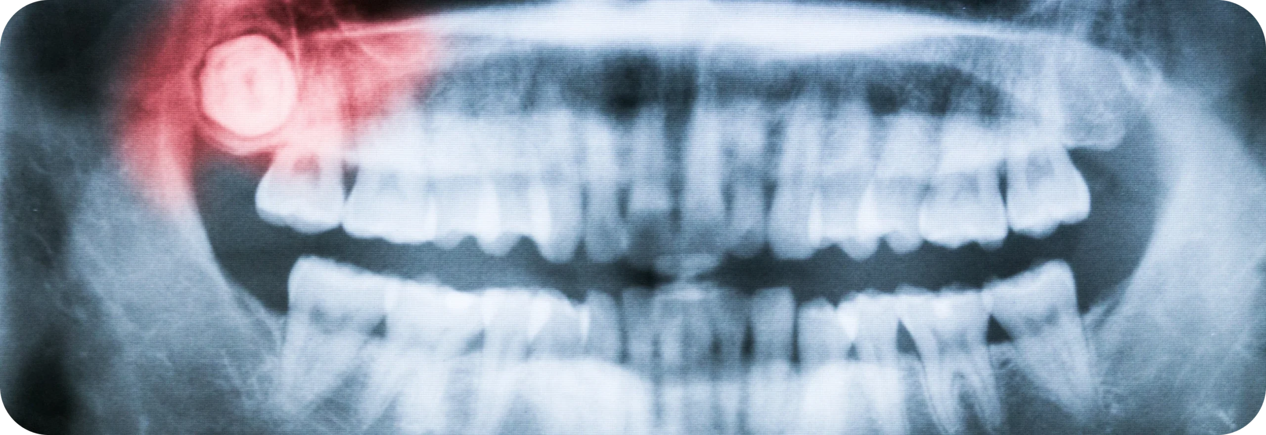 Dégagement de dents incluses  Dr Alexis Duroux, Dentiste à Cannes