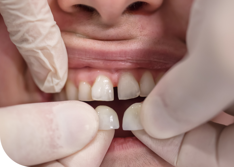 Facettes céramiques fines   Dr Alexis Duroux, Dentiste à Cannes