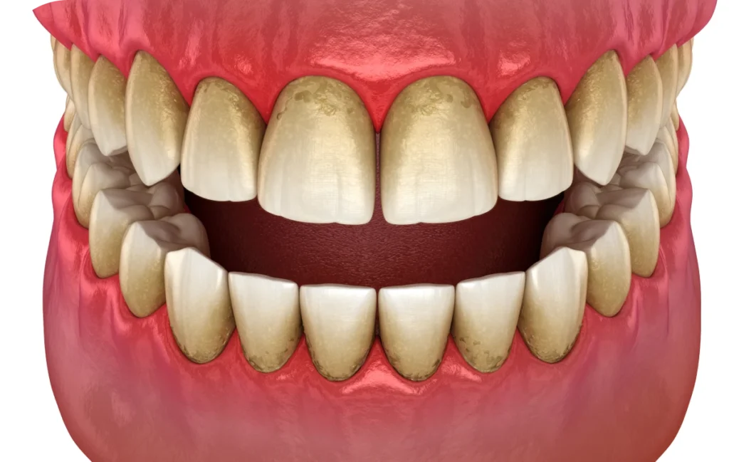 Dépistage des maladies parodontales  Dr Alexis Duroux, Dentiste à Cannes