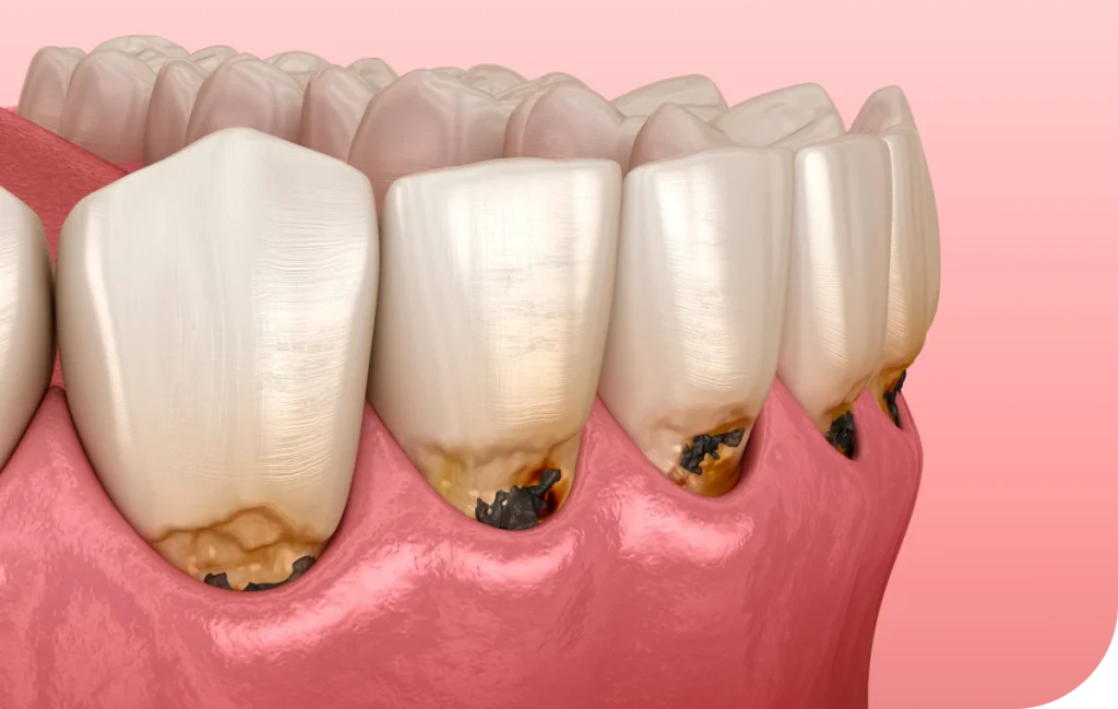 Dépistage des maladies parodontales  Dr Alexis Duroux, Dentiste à Cannes