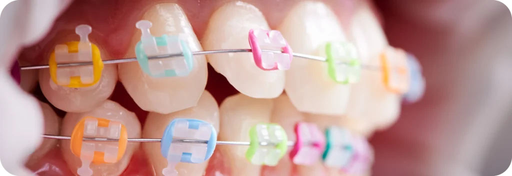 Élastiques Dr Alexis Duroux, Dentiste à Cannes