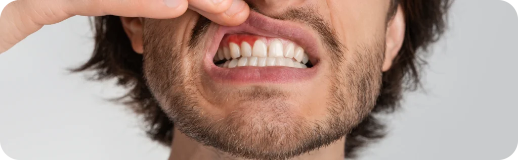 Traitement des gencives  Dr Alexis Duroux, Dentiste à Cannes