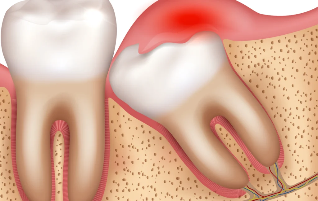 Extractions de dents incluses  Dr Alexis Duroux, Dentiste à Cannes
