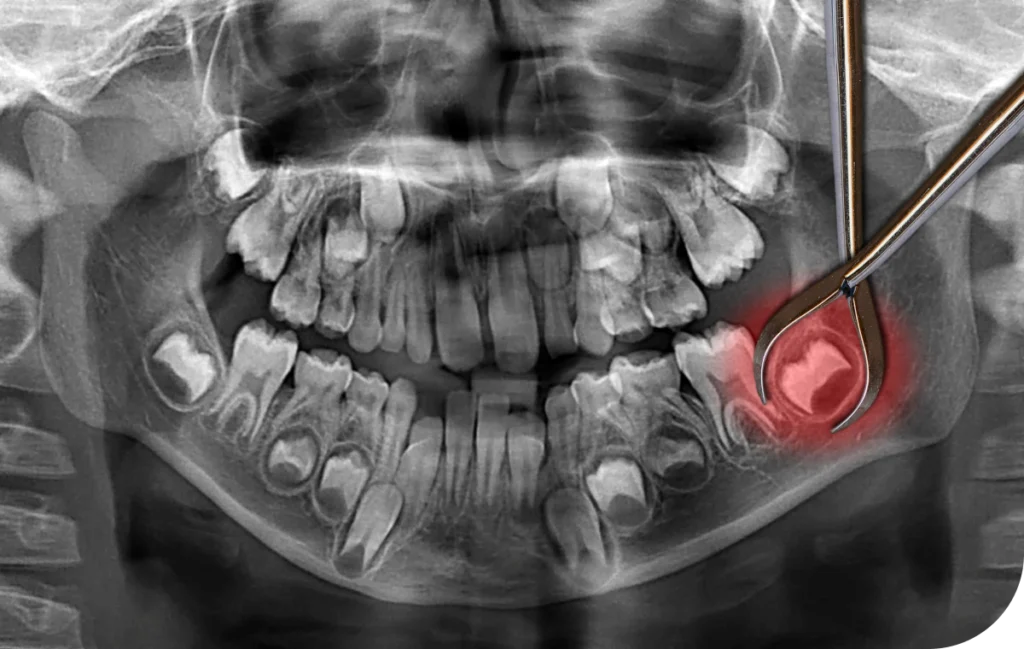 Extractions de dents incluses  Dr Alexis Duroux, Dentiste à Cannes
