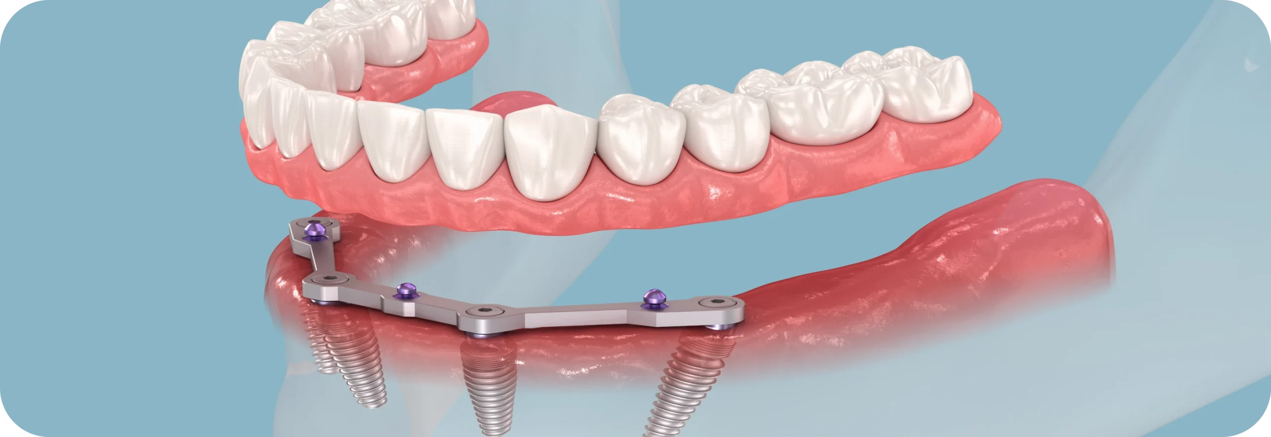 Prothèse sur implants  Dr Alexis Duroux, Dentiste à Cannes
