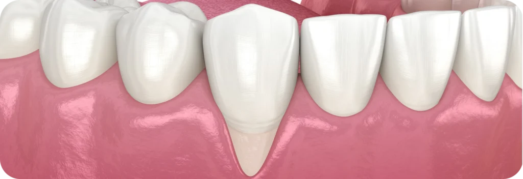 Greffe de gencive  Dr Alexis Duroux, Dentiste à Cannes