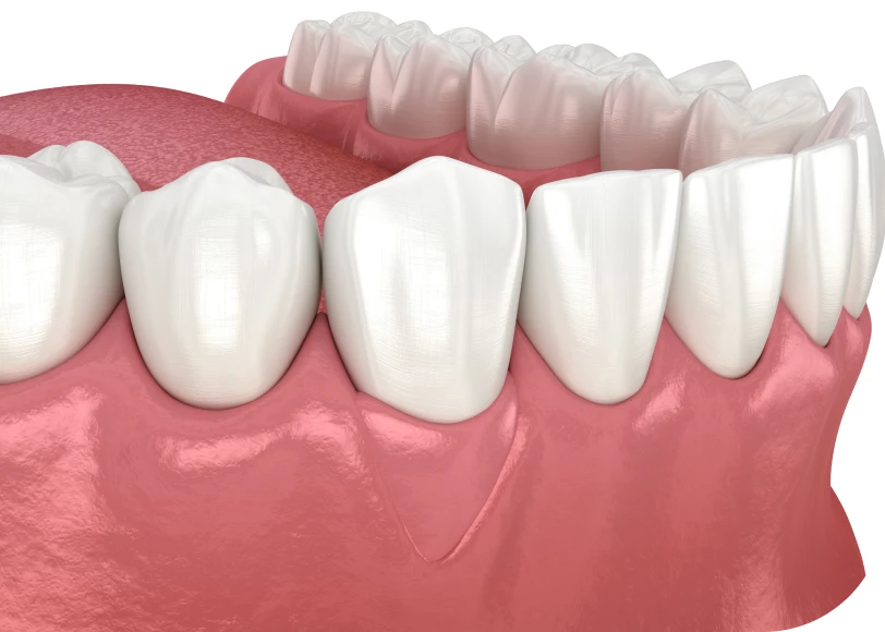 Greffe de gencive  Dr Alexis Duroux, Dentiste à Cannes