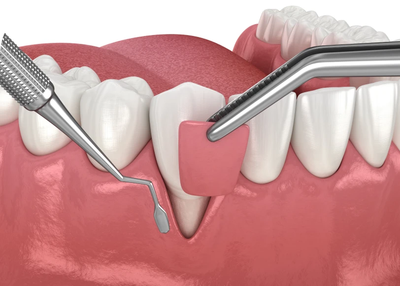 Greffe de gencive  Dr Alexis Duroux, Dentiste à Cannes