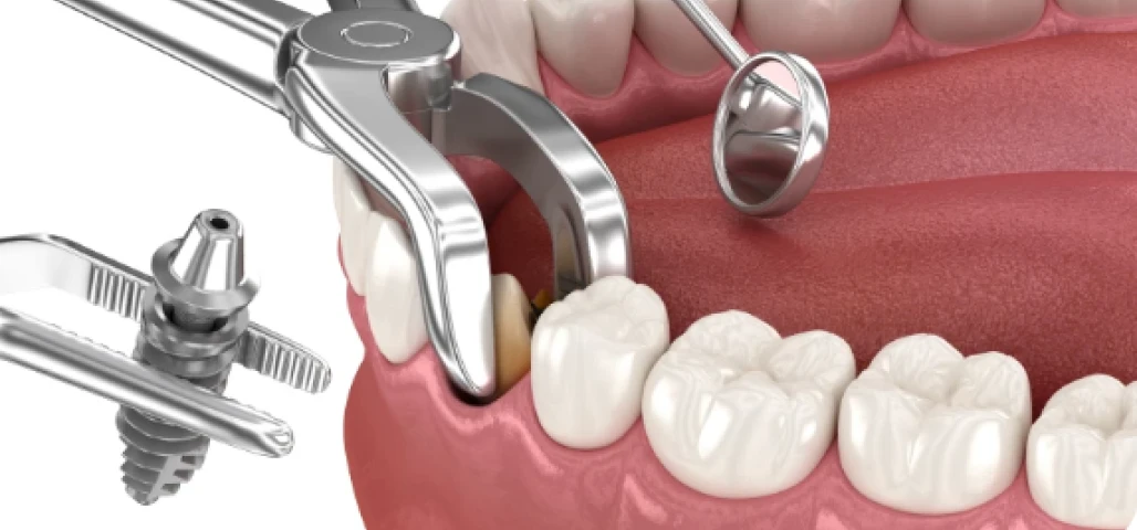 Implantologie immédiate 