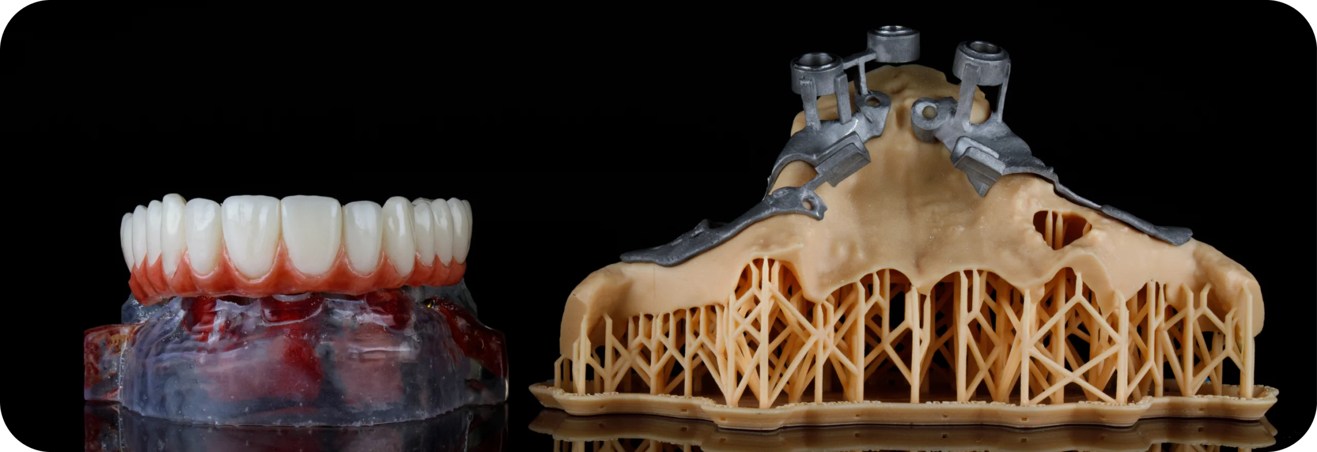 Implant sous-périosté  Dr Alexis Duroux, Dentiste à Cannes