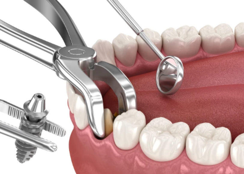 Implantologie immédiate  Dr Alexis Duroux | Dentiste à Cannes