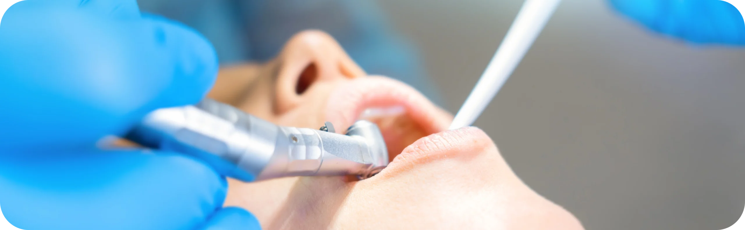 Implantologie immédiate  Dr Alexis Duroux | Dentiste à Cannes
