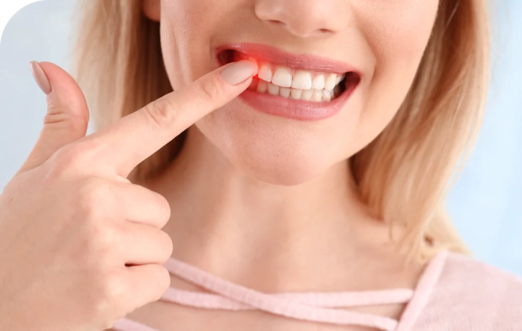 Maladie parodontale Dr Alexis Duroux, Dentiste à Cannes