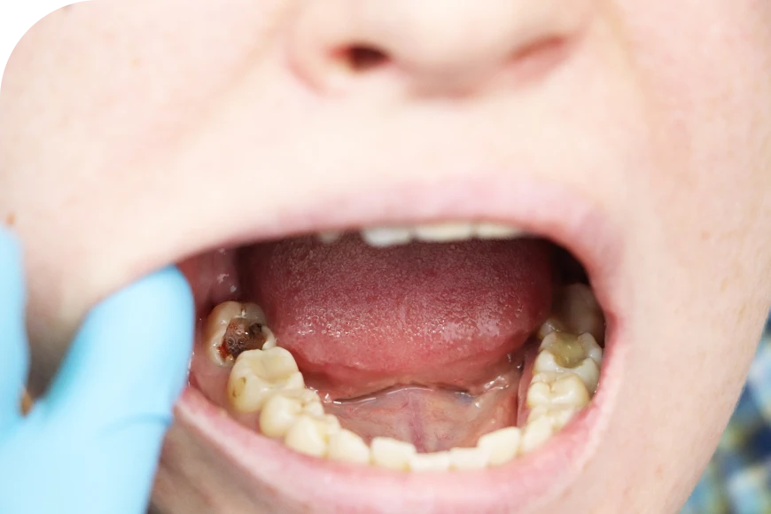 Traitement pédiatrique Dr Alexis Duroux, Dentiste à Cannes