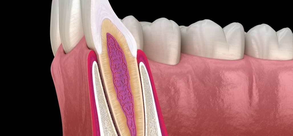 Le retraitement endodontique