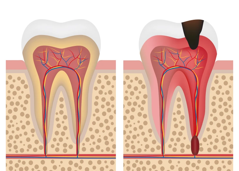 Le traitement endodontique  Dr Alexis Duroux, Dentiste à Cannes