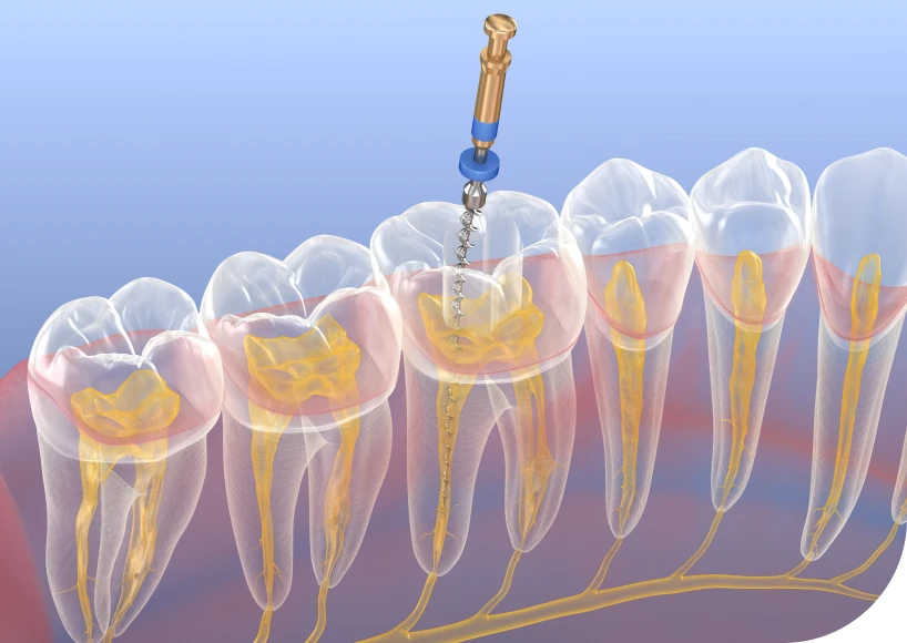 La chirurgie endodontique Dr Alexis Duroux, Dentiste à Cannes