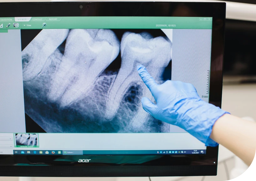 Le retraitement endodontique Dr Alexis Duroux, Dentiste à Cannes