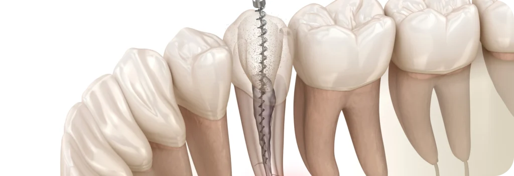 Le traitement endodontique  Dr Alexis Duroux, Dentiste à Cannes