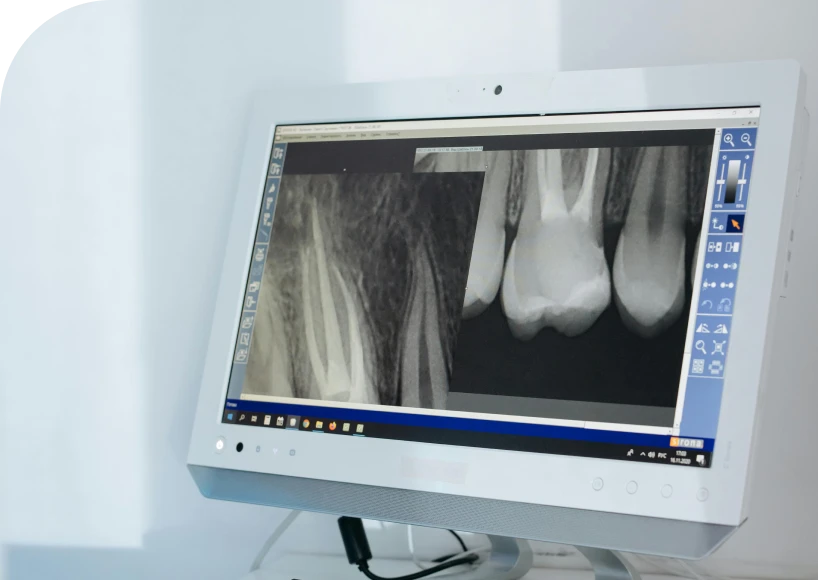 La chirurgie endodontique Dr Alexis Duroux, Dentiste à Cannes