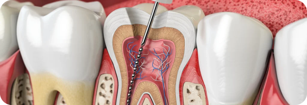 Le retraitement endodontique Dr Alexis Duroux, Dentiste à Cannes