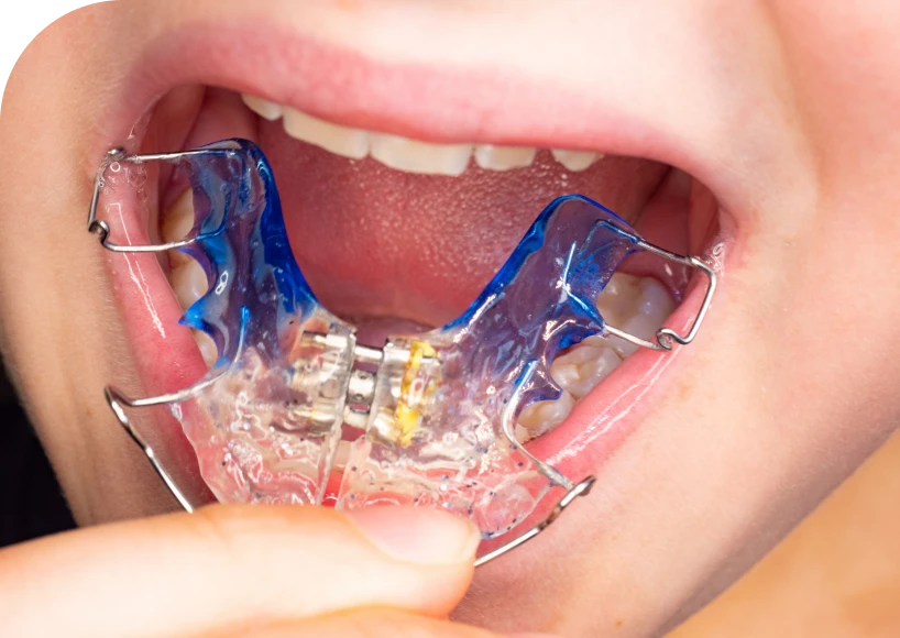 Le traitement d'interception Dr Alexis Duroux, Dentiste à Cannes